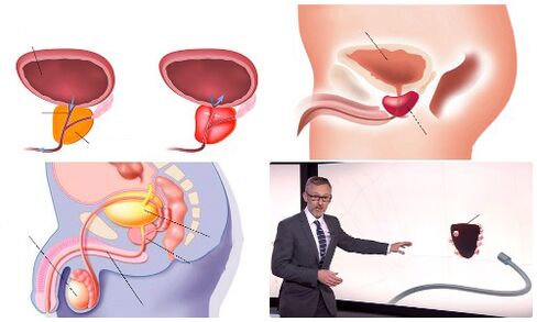 terve ja haige eesnääre